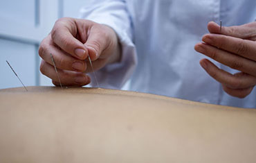 acupuntura